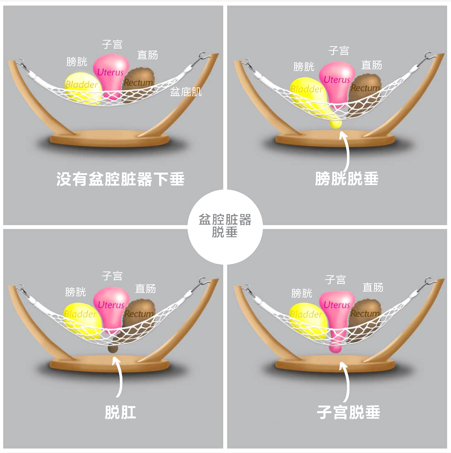 Pelvic floor muscle repair (3) Pelvic floor muscle repair (3)